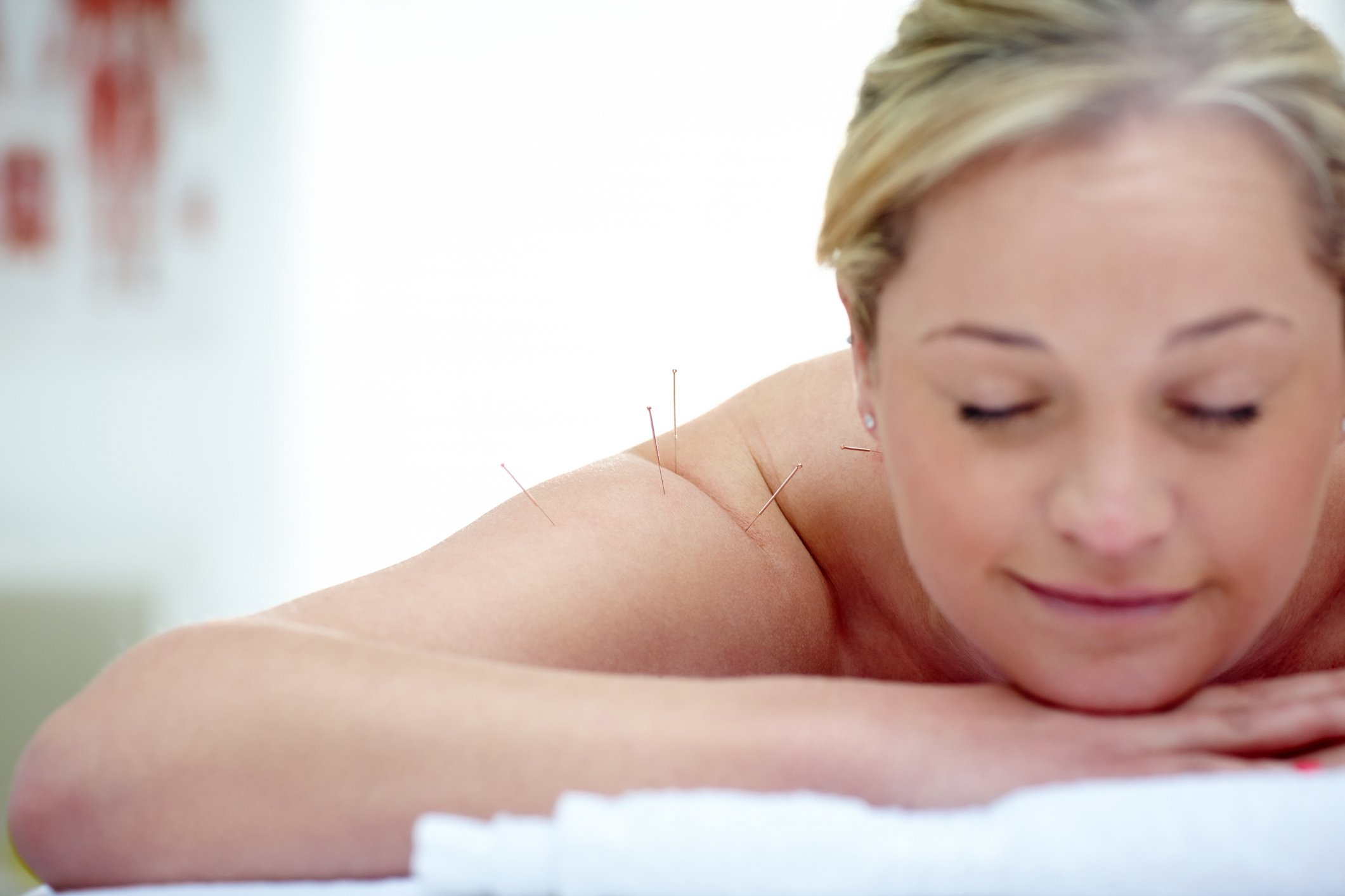 A woman laying face down on a towel while undergoing dry needling