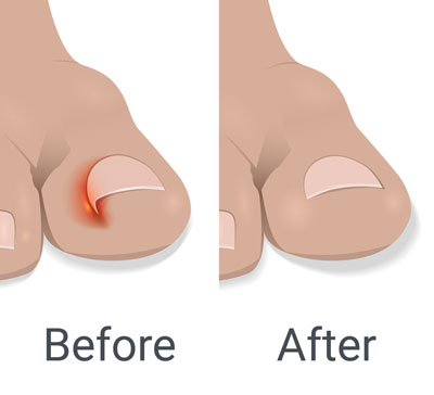 nail surgery 7.png